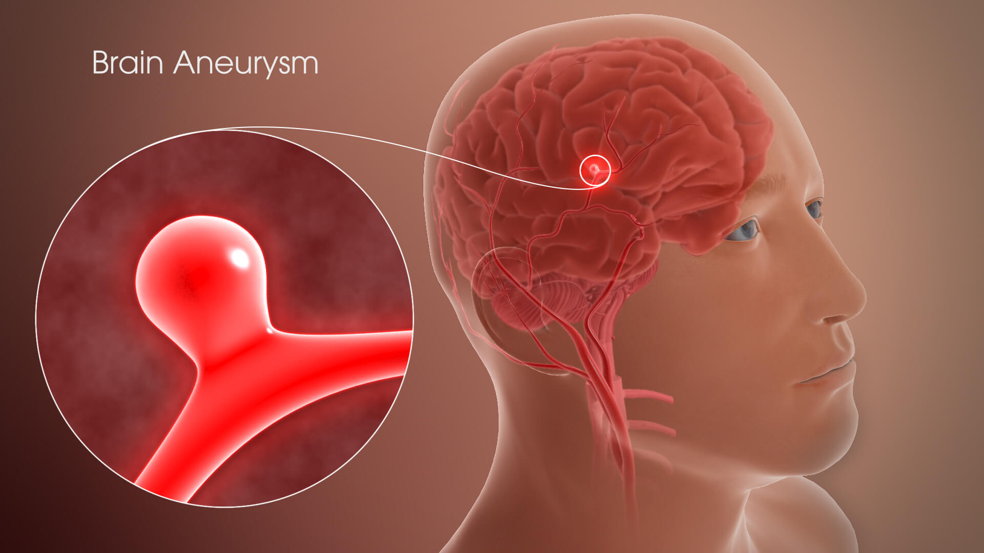 Understanding the Risks and Prevention of Brain Aneurysms